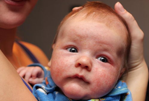 婴儿如何预防湿疹
